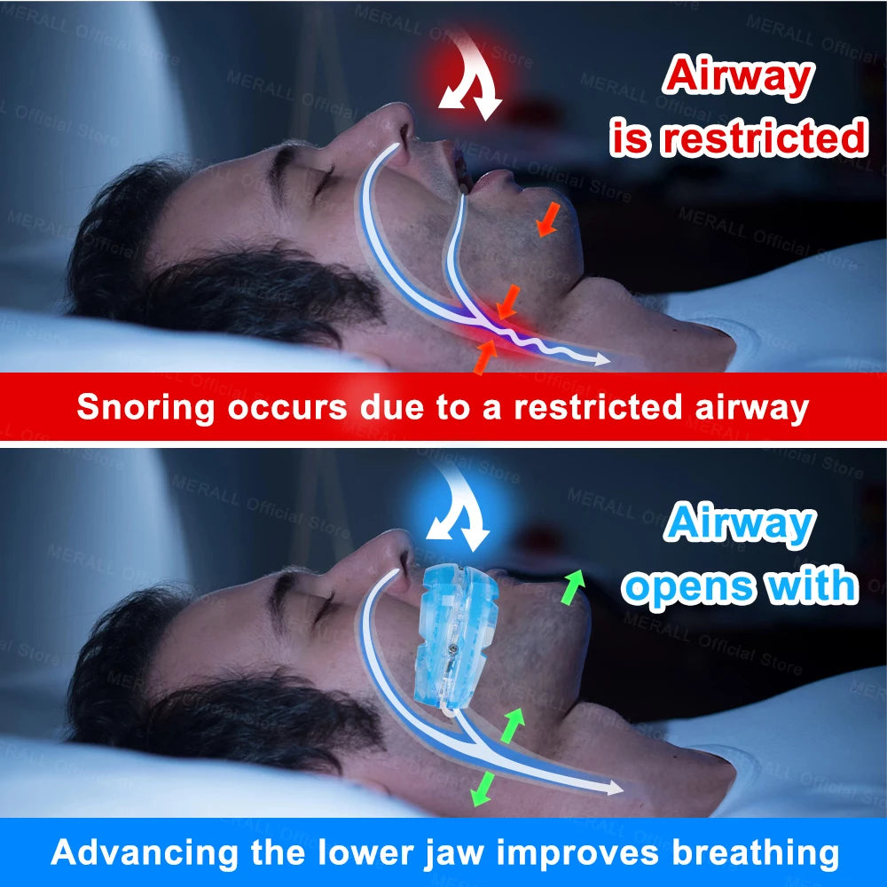 Adjustable Anti-Snoring Mouth Guard